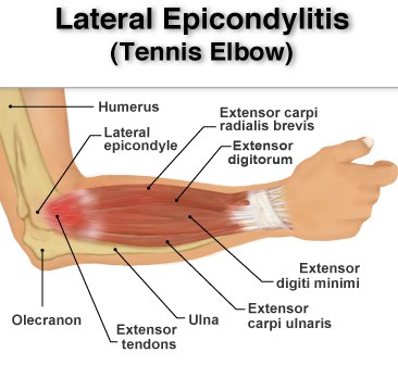 Lateral Epicondylitis - involved muscles